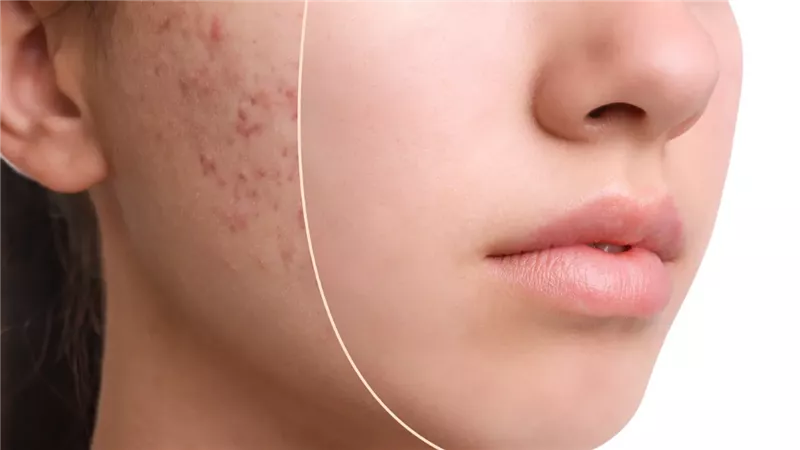 5 اسباب وراء حب الشباب في الثلاثينيات .. أسبابه وأفضل طرق علاجه لدى السيدات