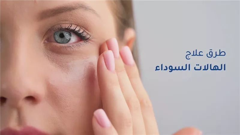 طرق صحية وفعالة للتخلص من الهالات السوداء وانتفاخ العين من أول مرة