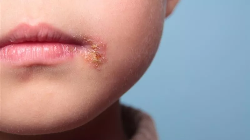 تصيب الأطفال .. الصحة تحذر من 3 أمراض خلال فصل الصيف وتوجه بكيفيه الحماية منها