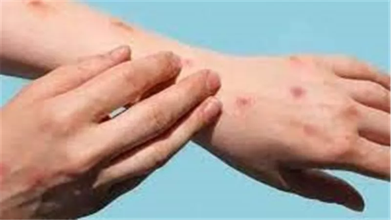 فيروس الهربس وأنتشاره بين الرضع وطلاب المدارس: اعراضه و طرق الوقاية و العلاج