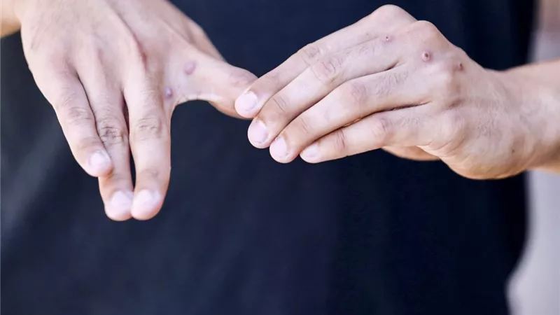 طارئ صحي عالمي يستدعي القلق .. الصحة توضح حقيقة رصد حالات إصابة بـ 