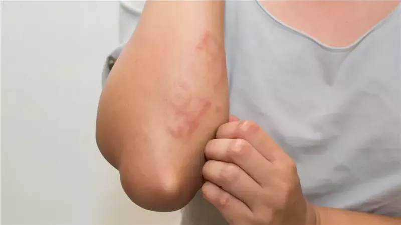 أعراض الجدري المائي وطرق الوقاية منه بعد أصابه العديد من طلاب المدارس