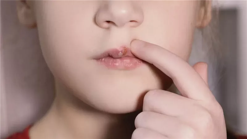 الهربس خطر يهدد الجسم .. فيروس قد يهدد طفلك بأعراض خطيرة (احذرو من تقبيل الرضع)