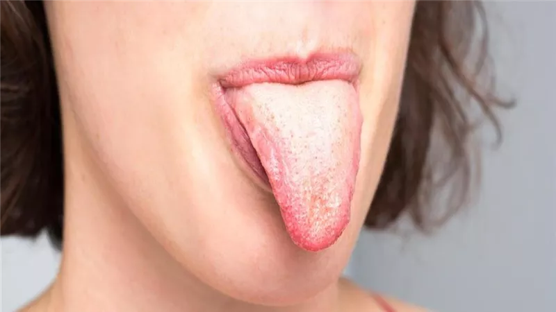 8 حلول طبيعيه لعلاج فطريات اللسان والفم.. وداعًا لتقرحات الفم