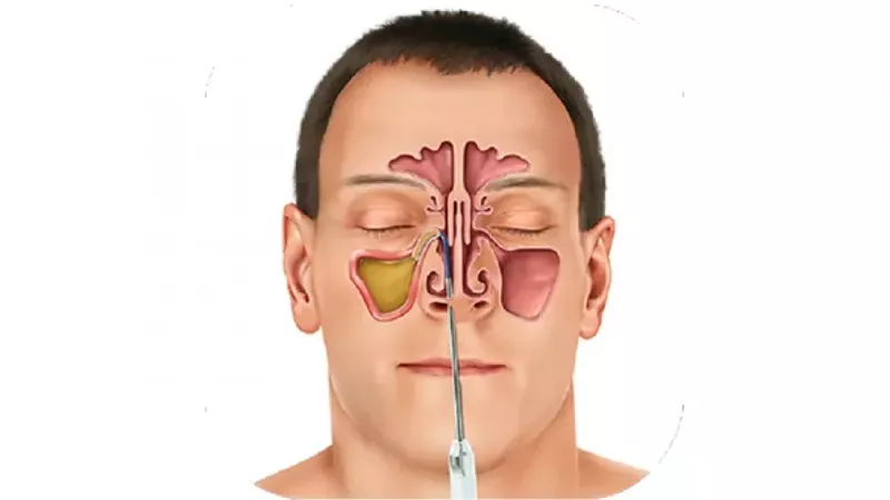 طرق علاج الجيوب الأنفية والوقاية من الالتهابات والحساسية